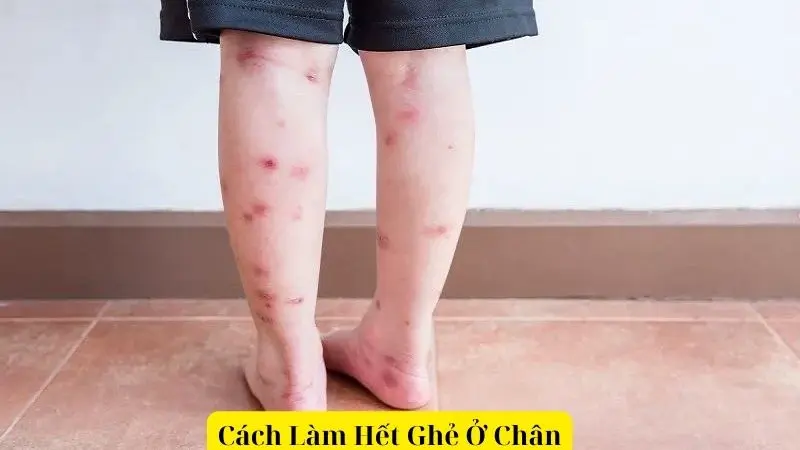 Cách Làm Hết Ghẻ Ở Chân