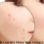 Cách Làm Hết Thâm Mụn Trong 1 Đêm