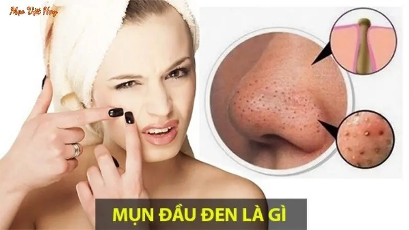 Mụn Đầu Đen Là Gì?